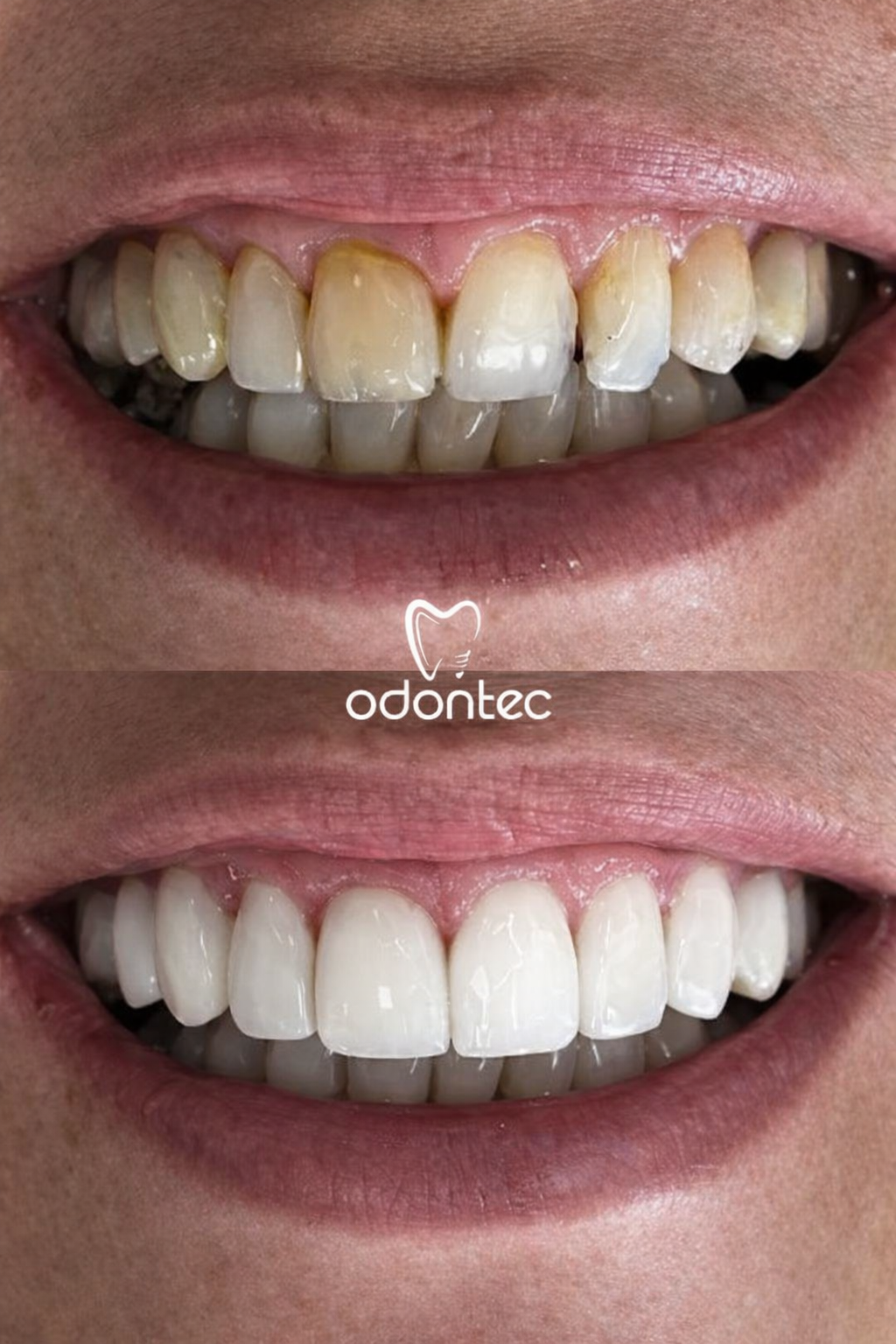 Antes e depois clareamento dental