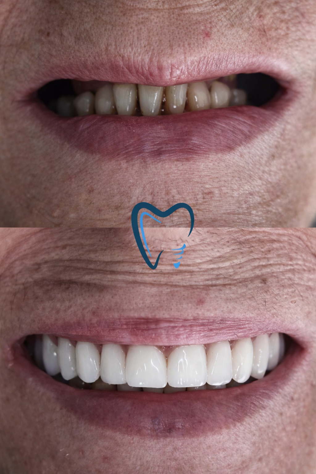 Antes e depois implante dentário