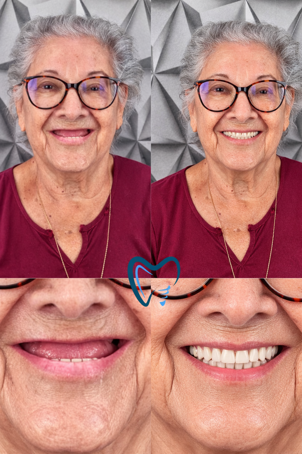 Antes e depois reabilitação oral